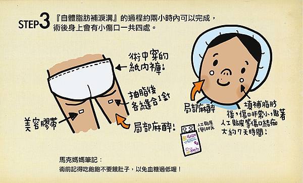  淚溝 黑眼圈 楊氏羅丹 眼袋 